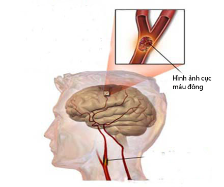 Thuốc làm tiêu cục máu đông trong nhồi máu não 1